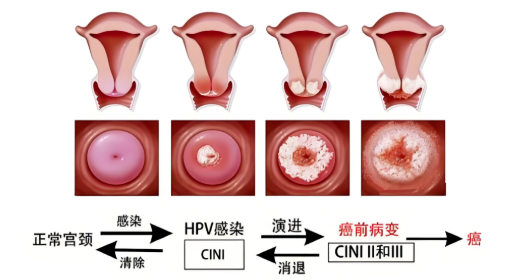 宮頸病變是什么原因引起的