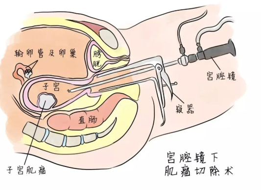 宮腔鏡手術(shù)對(duì)子宮傷害大嗎