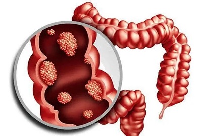 北京2025年腸癌早篩冬季 結(jié)腸息肉的病因主要有哪些？