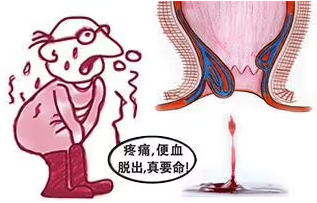 大便出血別慌！做好這5個日常護理，快速止血不遭罪！