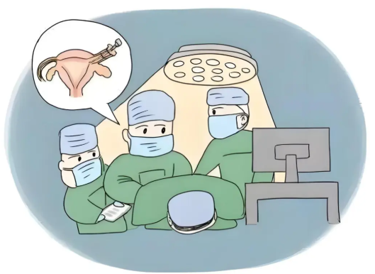 子宮腺肌癥手術(shù)