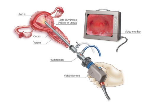 宮腔鏡檢查和宮腔鏡手術(shù)一樣嗎