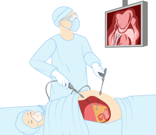 做過腹腔鏡懷孕率高嗎