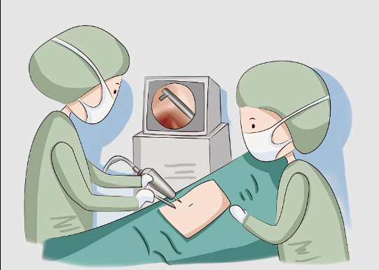 腹腔鏡闌尾炎手術(shù)費用