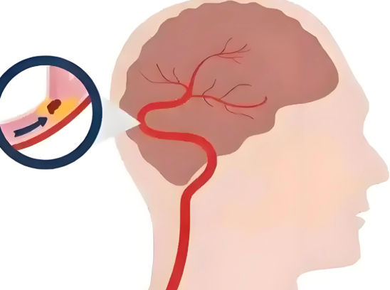 腦血管造影后多久下床