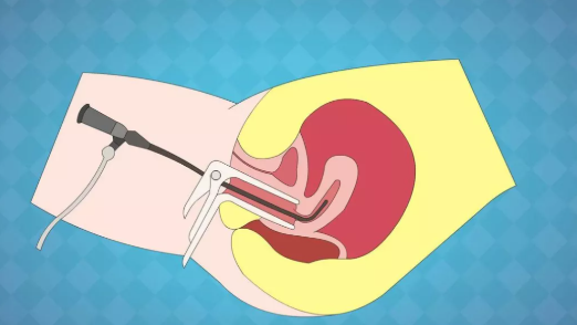 宮腔鏡清宮是小手術(shù)嗎