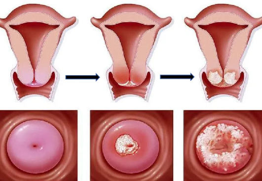 宮頸病變正規(guī)是不是很嚴重