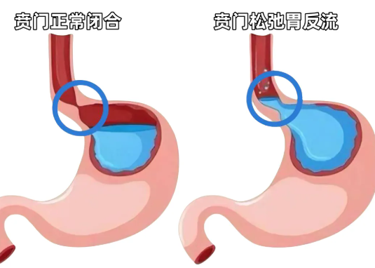 賁門失弛緩癥手術(shù)后會復(fù)發(fā)嗎