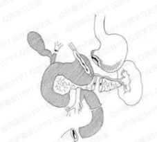 胰十二指腸切除術(shù)后護理