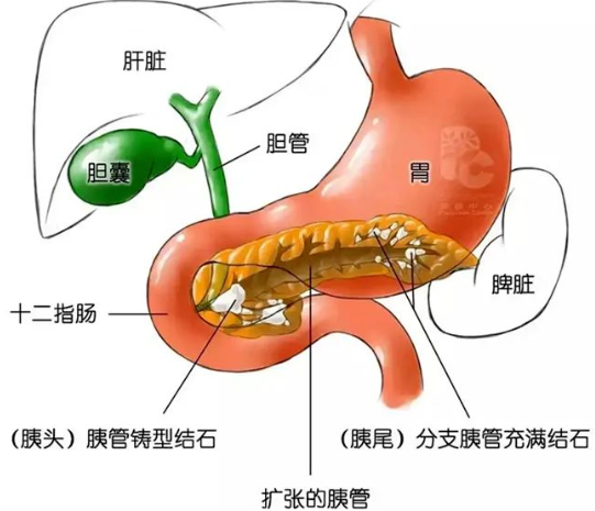 胰管結(jié)石是怎么引起的