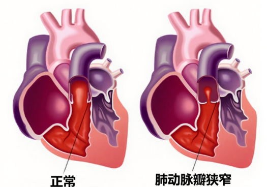 肺動脈瓣狹窄 較佳治療時間