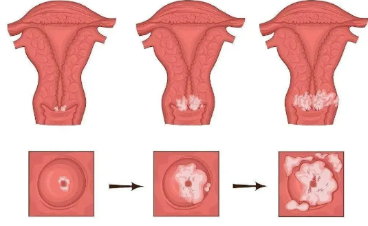 宮頸發(fā)生病變怎么處理