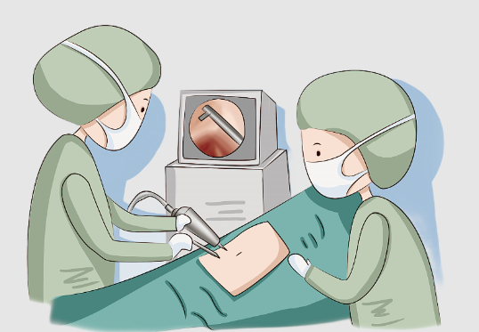 腹腔鏡闌尾炎手術