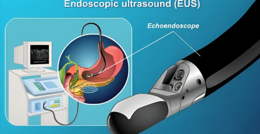 超聲內(nèi)鏡eus檢查是什么