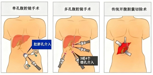 腹腔鏡膽囊切除術(shù)多久出院