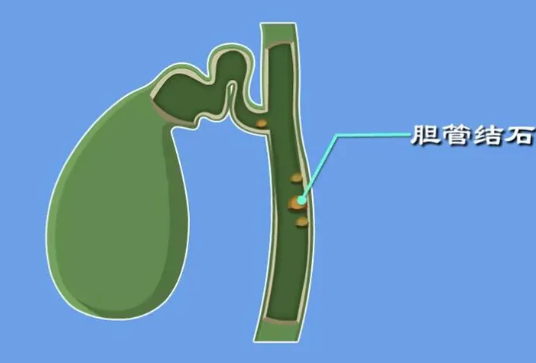 膽囊管有結(jié)石怎么辦