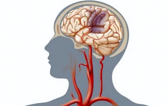 腦血管重度狹窄可以保守治療嗎