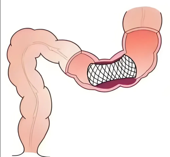 腸道支架植入術(shù)優(yōu)缺點(diǎn)