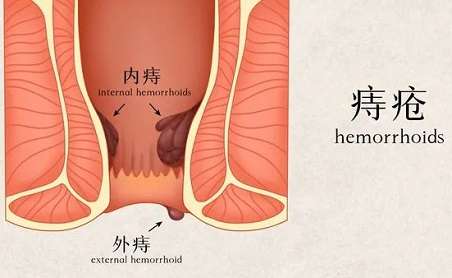 北京治痔瘡的醫(yī)院哪家好？久站久坐的人如何避免痔瘡？