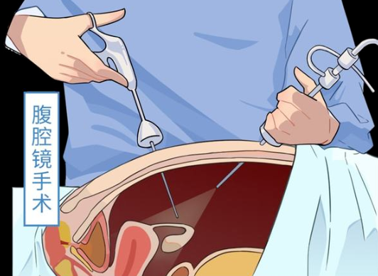 什么情況下才做腹腔鏡