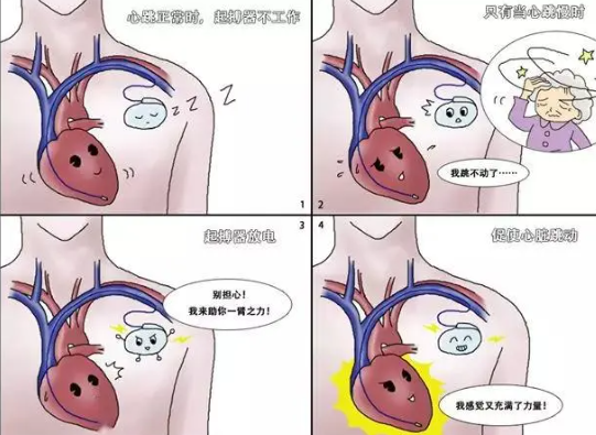 心臟起搏器實際就是給心臟埋了