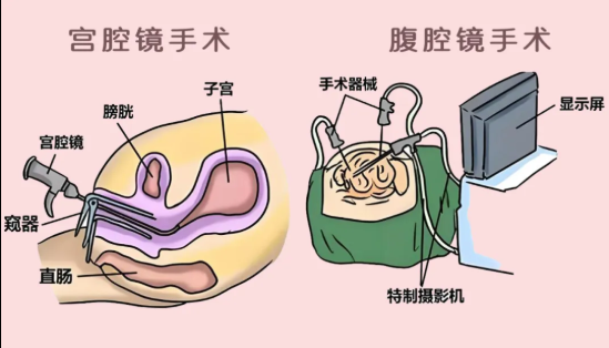 宮腹腔鏡是微創(chuàng)手術嗎