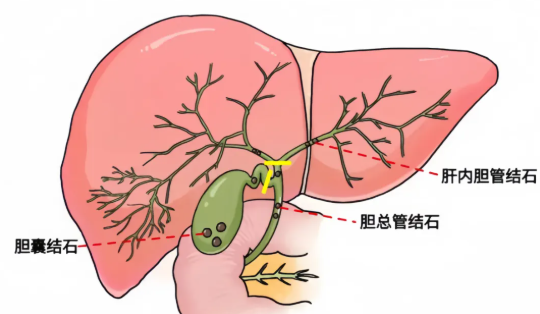 肝膽管結石有什么癥狀和表現(xiàn)