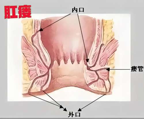 肛瘺有癌變可能嗎？肛瘺會(huì)不會(huì)遺傳？如果不治療會(huì)有哪些危害？？