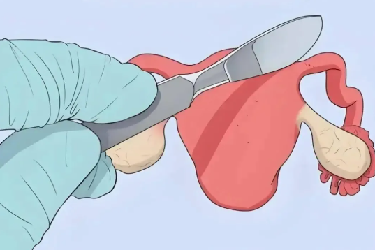 子宮摘除是大手術嗎