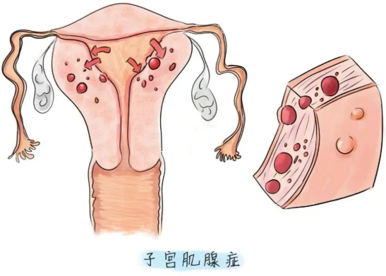 什么叫子宮腺肌癥