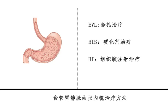 食管曲張靜脈怎么治療