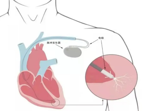 人工心臟起搏器