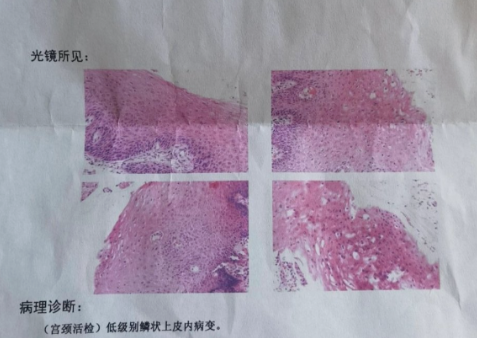 子宮頸低級別鱗狀上皮內(nèi)病變