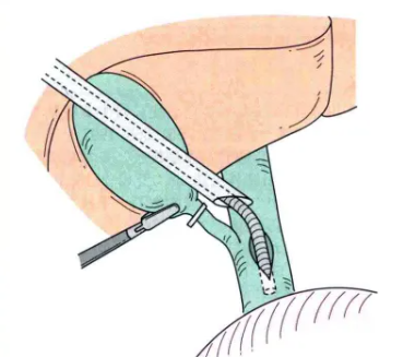 腹腔鏡膽總管切開取石術(shù)手術(shù)步驟