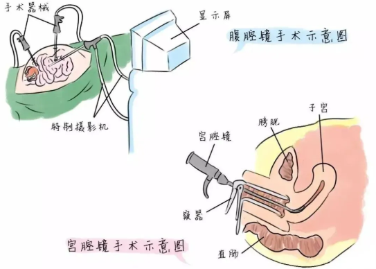 腹腔鏡和宮腹腔鏡的區(qū)別