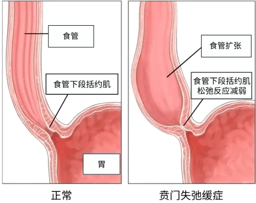 賁門失弛緩癥能自愈嗎