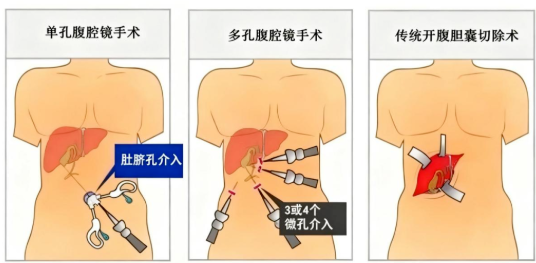 腹腔鏡膽囊切除術(shù)需要住院幾天