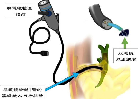 膽道鏡取石術(shù)手術(shù)費用