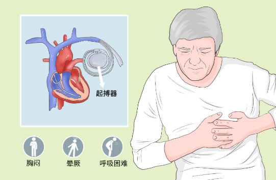 心臟起搏器的后遺癥有哪些