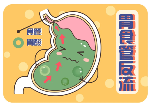 胃食管反流是什么病嚴(yán)重嗎