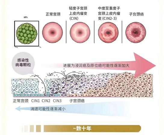 宮頸低度鱗狀上皮內(nèi)病變是什么意思