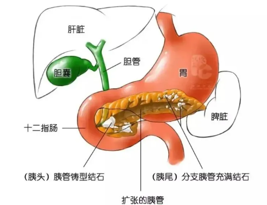 胰腺管結石嚴重嗎