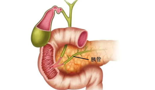胰腺管結石手術后能活多久