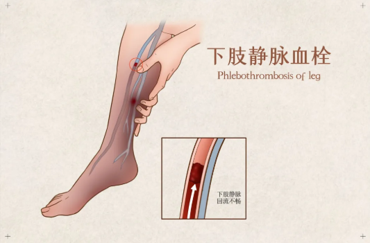 動脈血栓的癥狀 腿部怎么治療