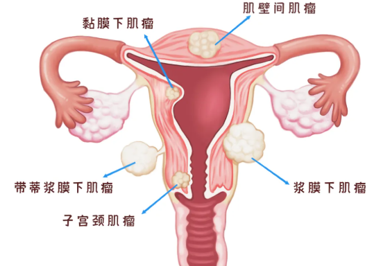 子宮腺肌癥伴腺肌瘤嚴重嗎