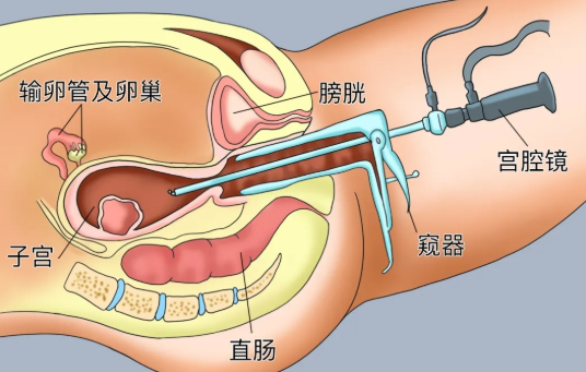 宮腔鏡多少錢做一次啊