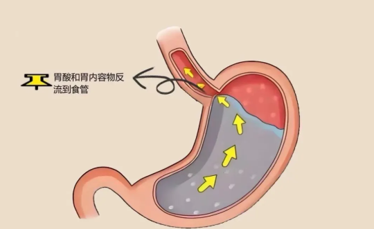 怎么治療食管反流