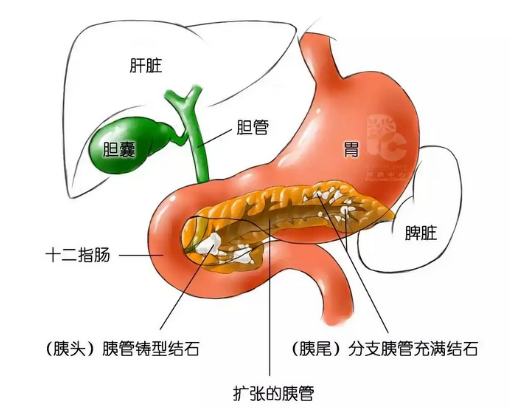 胰管結石碎石后能碎的干凈嗎