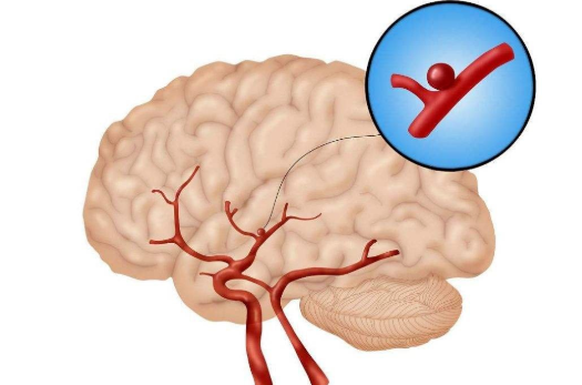 大腦后動脈狹窄怎么治療