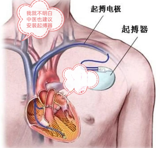 后悔安裝心臟起搏器